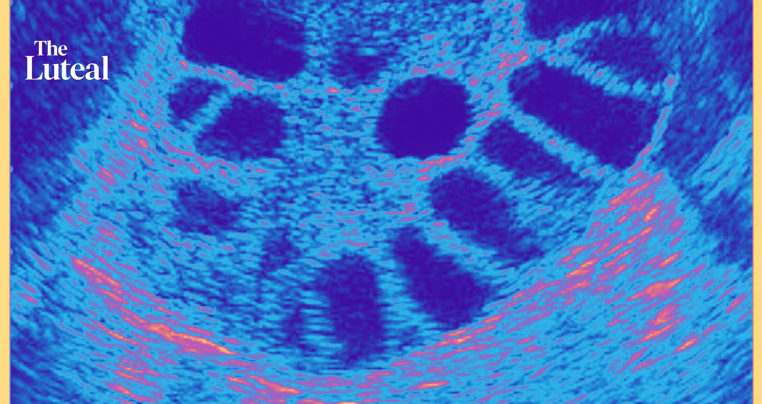 PCOS Is Officially PMOS — A One-Letter Change Aimed at Improving Women's Healthcare